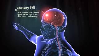 Types of cerebral palsy