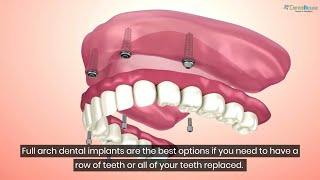 Dental Content Marketing Sample: Factors to Consider Before Getting Dental Implants - What to Know