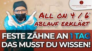 All on 4 / All on 6® - Wie läuft das ab? Für wen geeignet? Risiken und Vorteile im Detail!