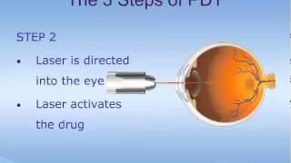 Visudyne Treatment for Age-Related Macular Degeneration (ARMD)