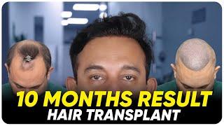 Hair Transplant in Mysore | Best Results & Cost of Hair Transplant in Mysore