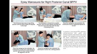Epley Manoeuvre for Right Posterior Canal BPPV
