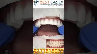 Durable graphene full arch teeth for dental implants -life changing smile in 5 days Chennai India!##