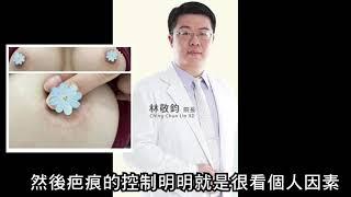 乳暈隆乳疤痕慘狀網友驚嚇，巨星診所林敬鈞環狀奶嘴乳頭疤，陳彥州醫師新冠病毒乳頭疤，還找寫手狂推害慘消費者，蕾拉狀況堪憂強顏歡笑，手術失敗醫療糾紛負面評價一大堆