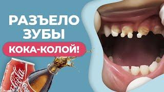 Что делает кока-кола с зубами? / Вред колы для зубов