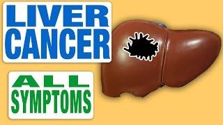 Liver Cancer - All Symptoms