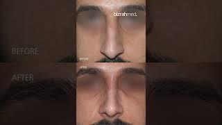 Rhinoplasty Before And After Result : Dr. Bashar Bizrah/ London/Dubai