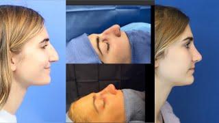 Magical Transformation - Teen Rhinoplasty | Plastic Surgery by Dr. Ali Sajjadian | Before & After