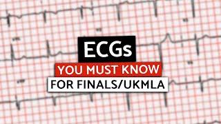 MUST KNOW ECGs for Med School Finals/UKMLA/PLAB | Rapid High-Yield ECGs