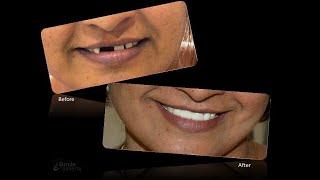 Dental Bridge ( LAVA CLASSIC) | To Restore missing tooth spaces | Anand | Gujarat