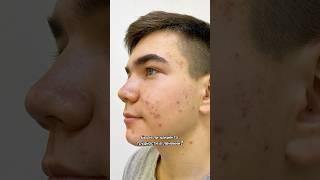 Мужчины должны лечить прыщи? Как ты считаешь? #акне #прыщи