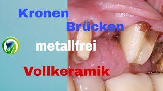 Patientenfall Kronen und Brücken metallfrei/  aus Vollkeramik, Zirkon, Glaskeramik, Lithiumdisilikat