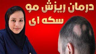 بهترین درمان ریزش مو سکه ای: ریزش مو سکه ای چیست و و چه عواملی باعث ریزش مو سکه ای می شود