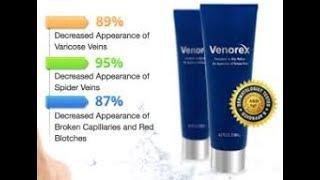 ehowhealth  - How to Remove Varicose Veins - ehowhealth