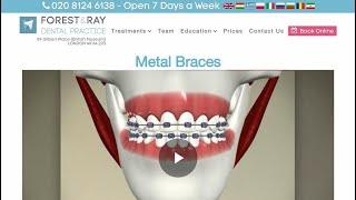 Metal Braces London - Forest & Ray - Dentists, Orthodontists, Implant Surgeons