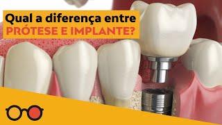 Qual a diferença entre prótese e implante? | plantão de dúvidas