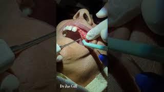 Dr Jas Gill- Extraction