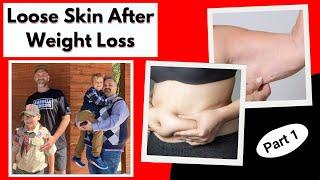 Loose Skin After Weight Loss: Causes and Prevention Strategies