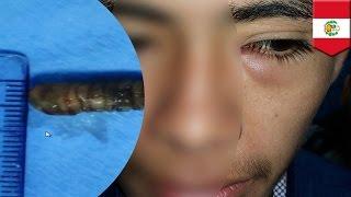 Dokter mengeluarkan cacing dari mata anak remaja - Tomonews