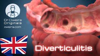 How to protect yourself from Diverticulitis | Dr.Oweira Platform