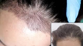 Transformative 2-Week Results: SMART FUE Hair Transplant | Glojas Aesthetic Clinic