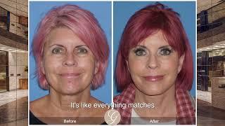 62 Year Young Facial Rejuvenation | Dr. Kevin Sadati