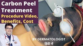 Carbon Peel Treatment In Hindi | Carbon Laser Facial Treatment | Carbon Facial In Jaipur | SkinEva