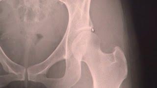 Hip Dysplasia & Surgery