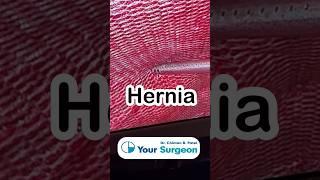What is Hernia Tacker & Mesh ?  Hernia Treatment in Surat , Gujarat I Inguinal , Umbilical hernia