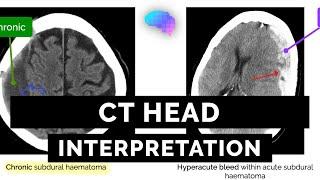 CT Head Interpretation for Beginners - OSCE Guide | UKMLA | CPSA