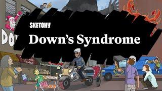 Down's Syndrome (Part 1) | Sketchy Medical | USMLE Step 1