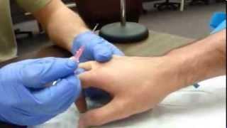 How to start an IV:  Dorsum of hand