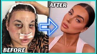 My Plastic Surgery Experience in Korea! (Facial Feminisation Surgery)  |  PART 2