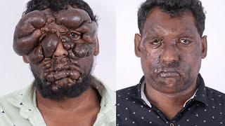 Ravikumar Face Tumor - 1 Year After Surgery