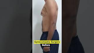 Gynecomastia Surgery | Gynecomastia cost  | Gynecomastia video