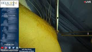 Watch Live Surgery! Left Ulnar Nerve Decompression at Elbow
