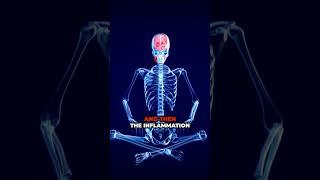 The Neurologic Destructive Sequence