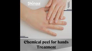 Chemical peel for hands treatment at skinaa clinic | Viral #shorts