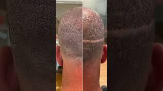 Hair transplant scar camouflage  #scalpmicropigmentation #hairtattoo #scar #scarstreatment