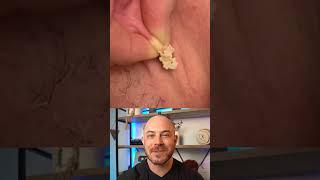 Derm reacts to HUGE ear cyst! #cystpop #dermreacts #doctorreacts