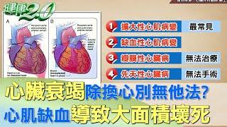 心臟衰竭除換心別無他法? 心肌缺血導致大面積心肌壞死  健康2.0