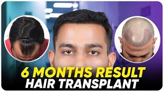 FUE Hair Transplant | Best Cost & Results of FUE Hair Transplant