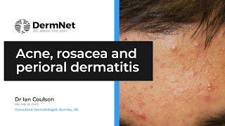 Acne, rosacea and perioral dermatitis