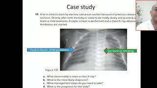 Case 98 Transient tachypnoea of the newborn TTN ,how to differentiate TTN from pneumonia  ,MAS