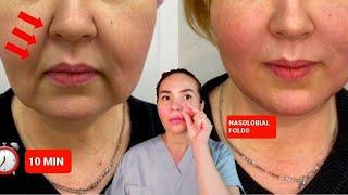 EFFECTIVE TECHNIQUES FOR THE NASOLABIAL FOLDS | NO WORDS