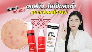 วิธีดูแลผิว ไม่ให้กลับไปเป็นสิวอีก ต้องจัดการครบทุกสัญญาณก่อสิว Neutrogena | แนน Sister Nan