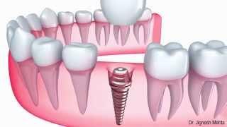 Dental Implant