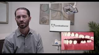 Cardinal Dental: Missing Tooth Options in La Mesa, CA