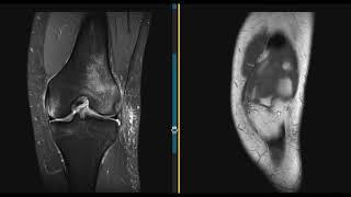 Normal ACL and ACL tear | First Look MRI