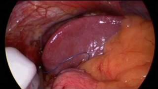PART 2 Live Gastric Banding operation explained by Dr Craig Taylor OClinic SYDNEY